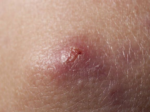 फोड़े का सामान्य चित्र